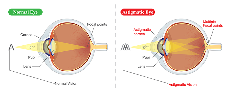 Astigmatism Grand Chute WI